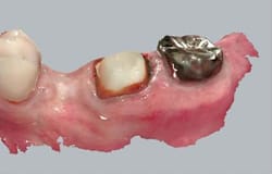 ボロボロの歯